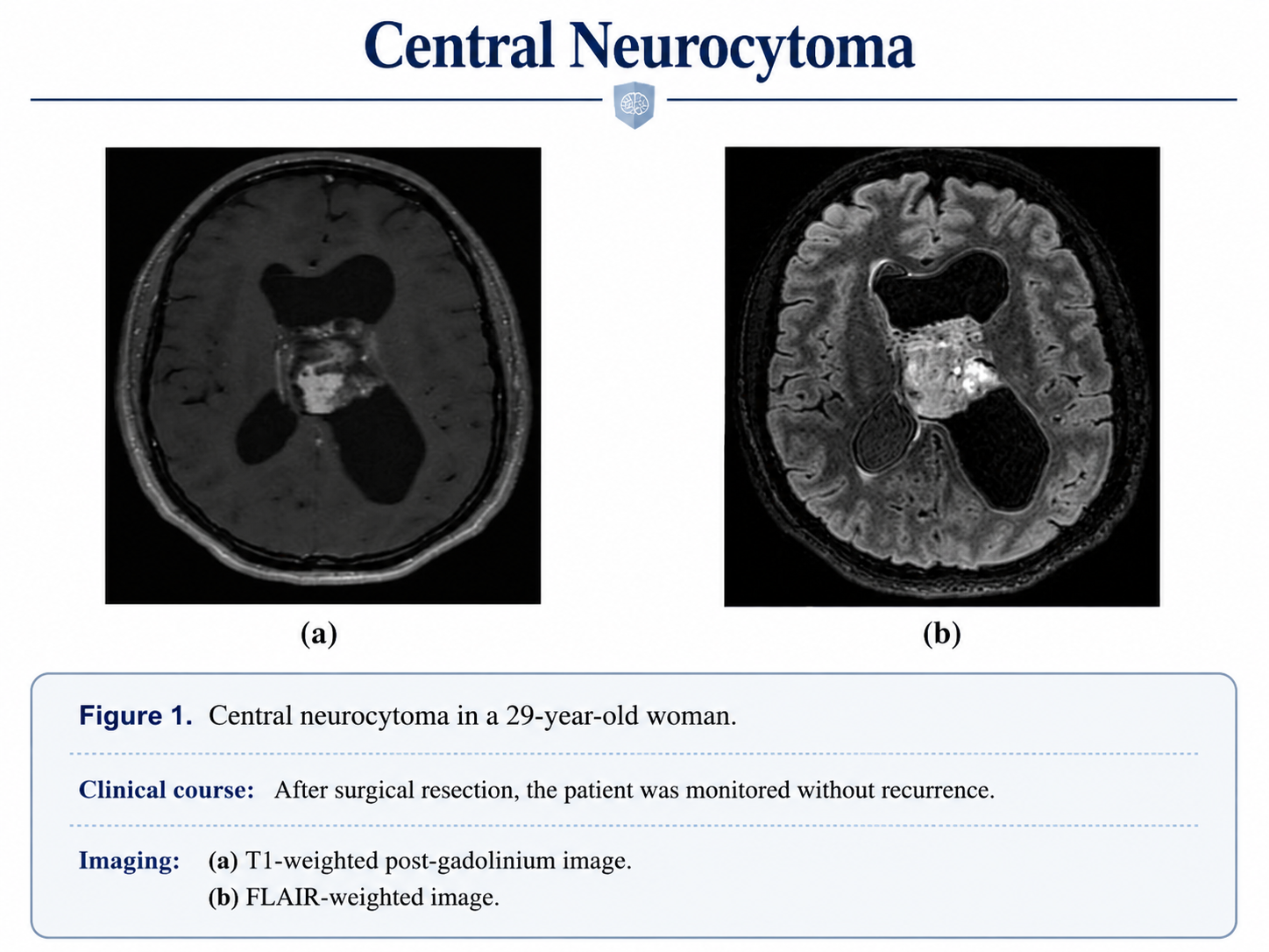 Central neurocytoma