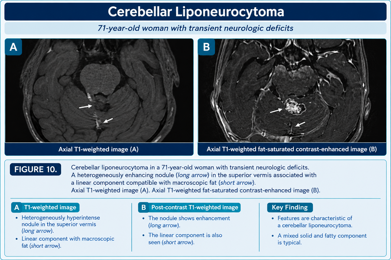 Cerebellar liponeurocytoma