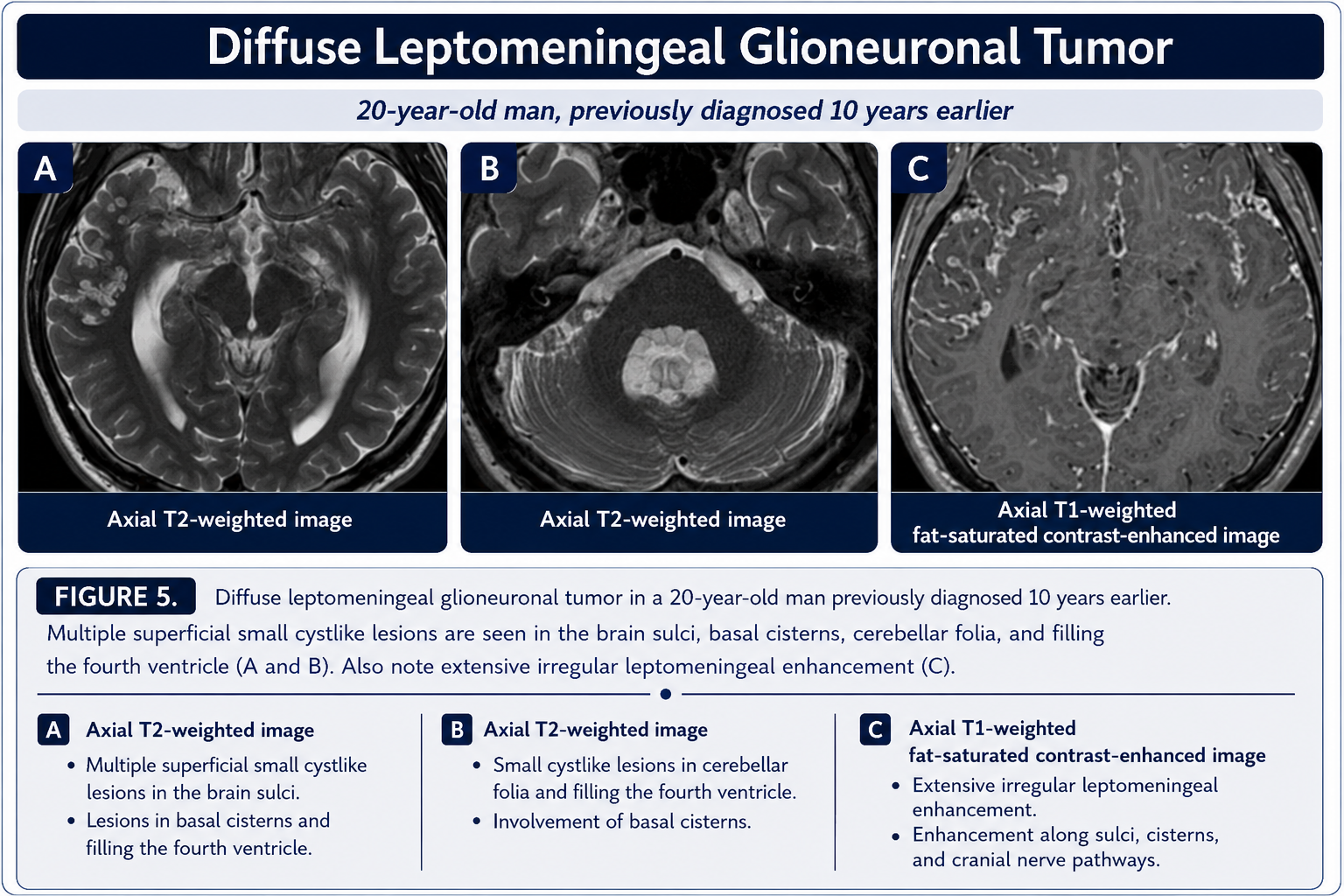 Diffuse leptomeningeal glioneuronal tumor