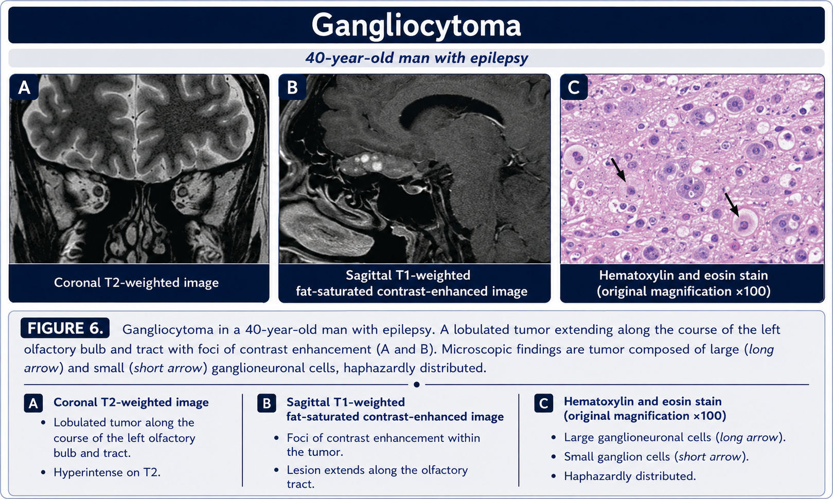Gangliocytoma