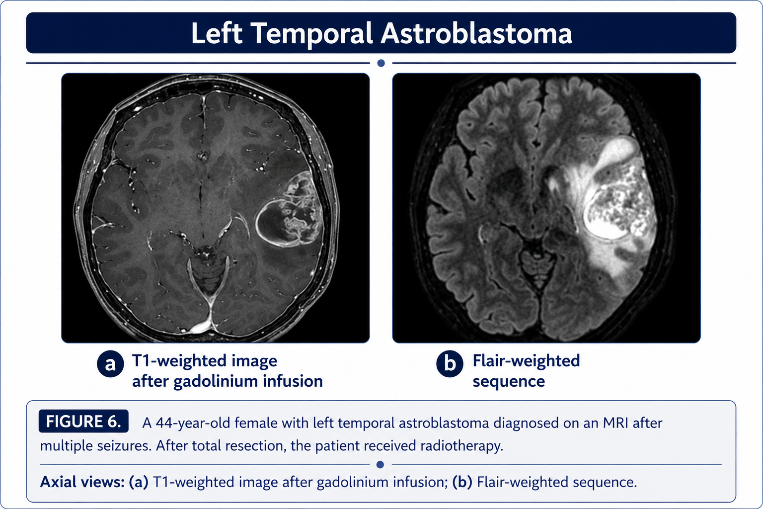 Left temporal astroblastoma