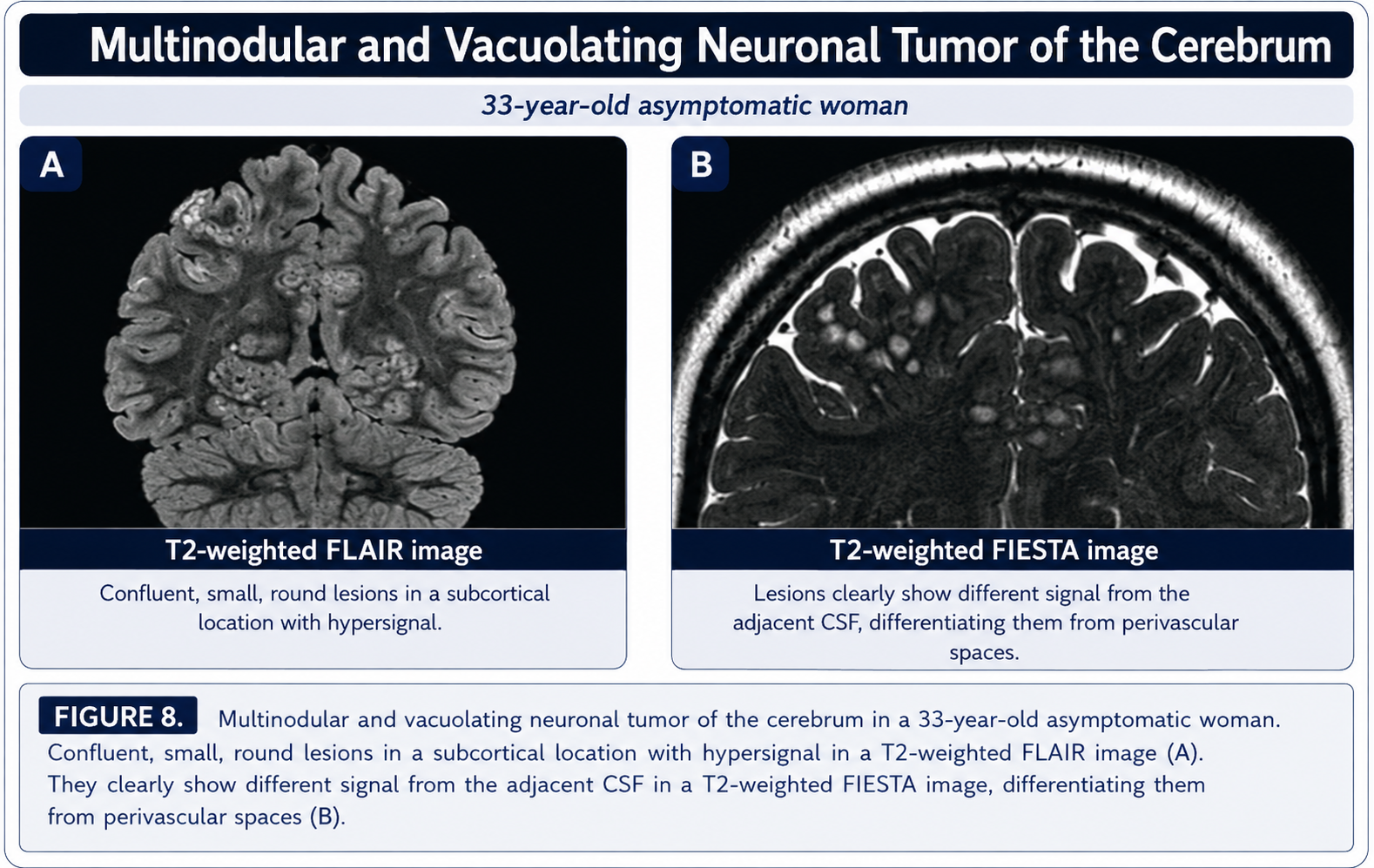 Multinodular and vacuolating neuronal tumor of the cerebrum