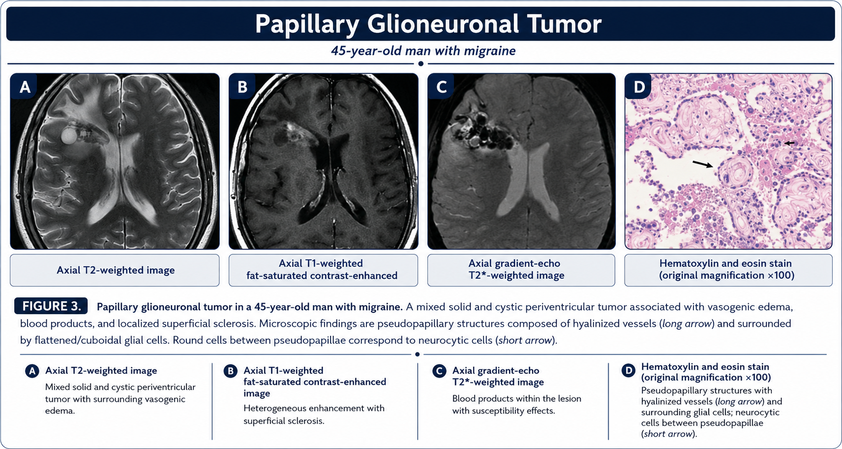 Papillary glioneuronal tumor