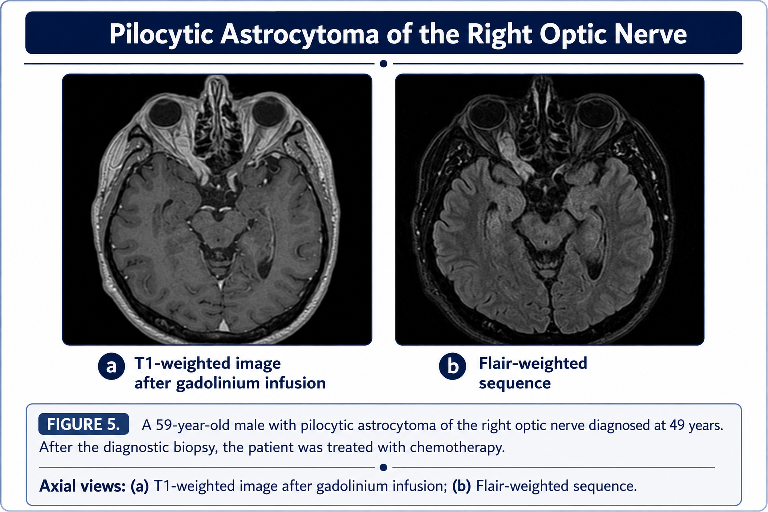 Pilocytic astrocytoma of the right optic nerve