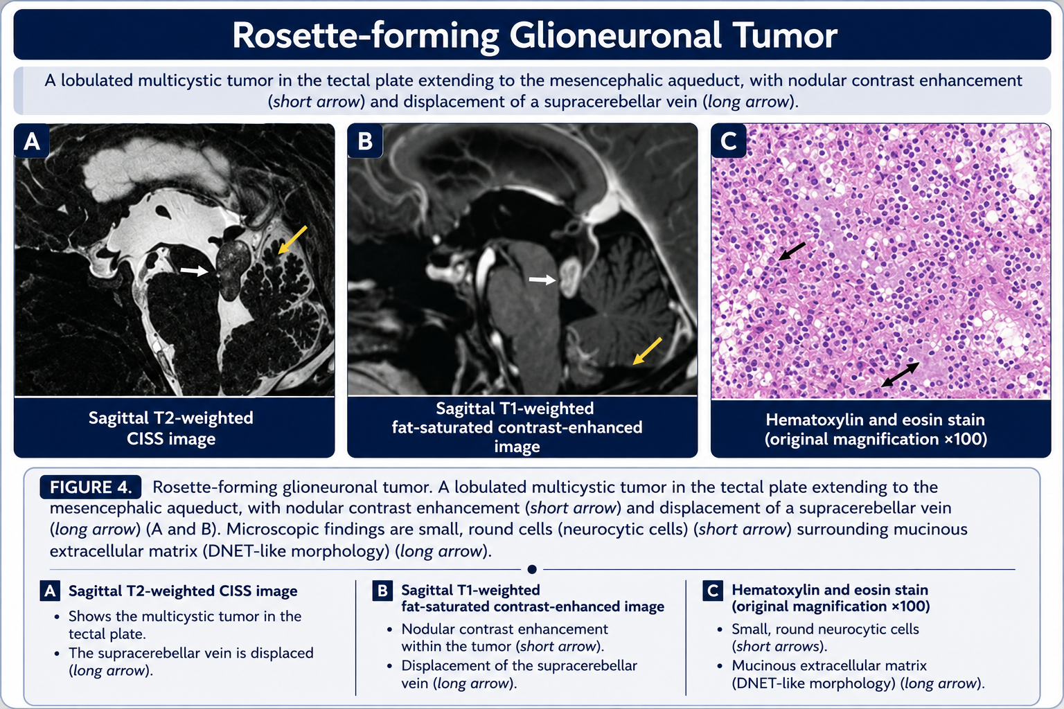 Rosette-forming glioneuronal tumor