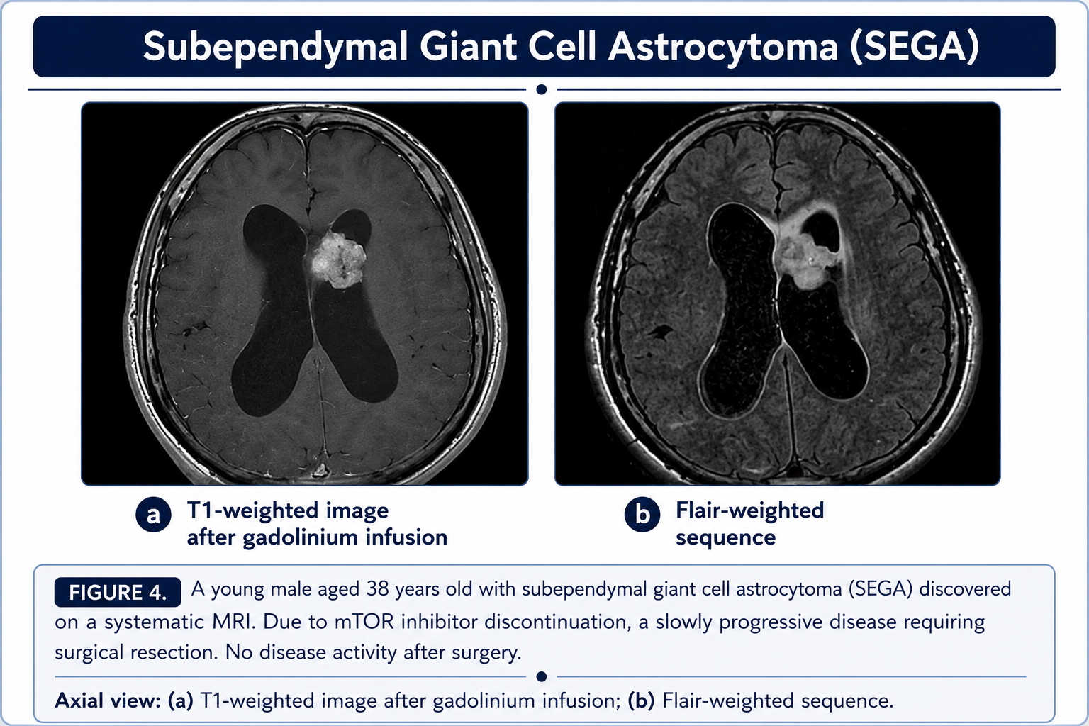 Subependymal giant cell astrocytoma