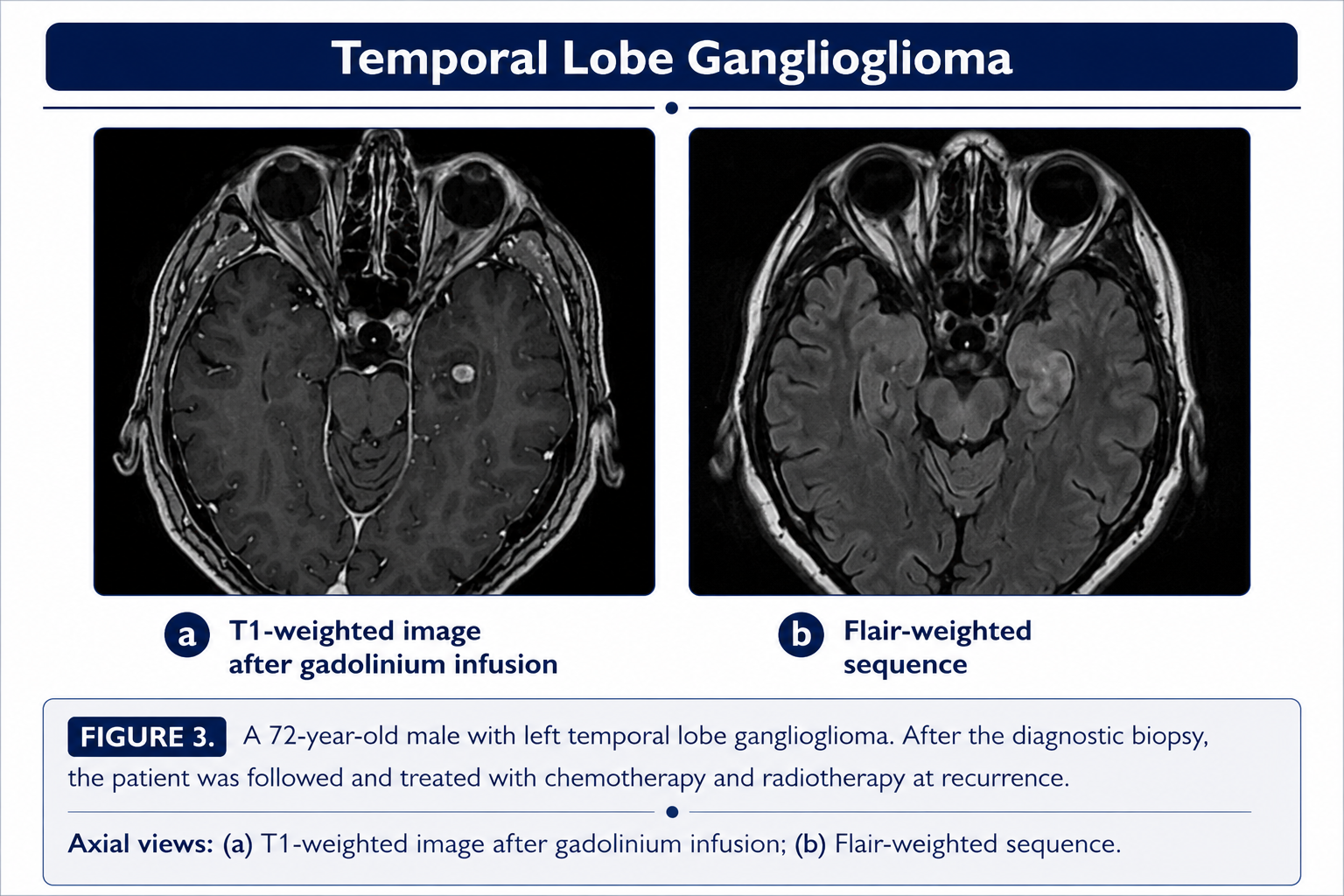 Temporal lobe ganglioglioma